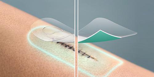 Image showing the application of a Leukoplast® film dressing on a stitched wound Image showing the application of a Leukoplast® film dressing on a stitched wound